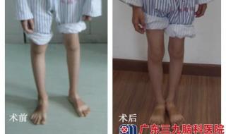 3岁男童手术后变脑瘫 3岁男童手术后变脑瘫