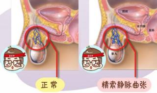 精索静脉曲张症状图